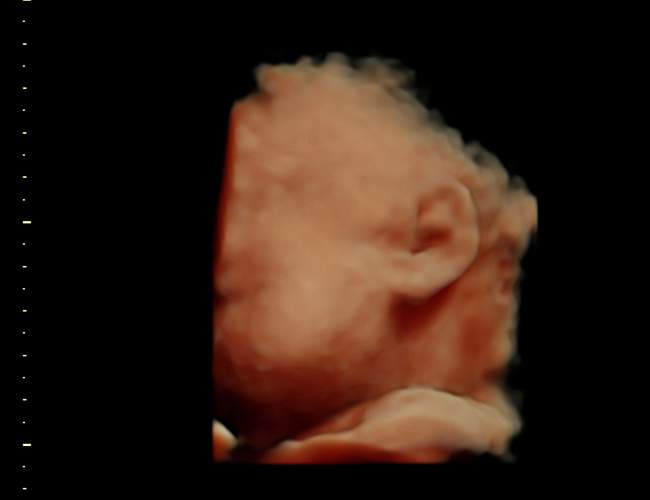 3D ultrasound image at 31 weeks